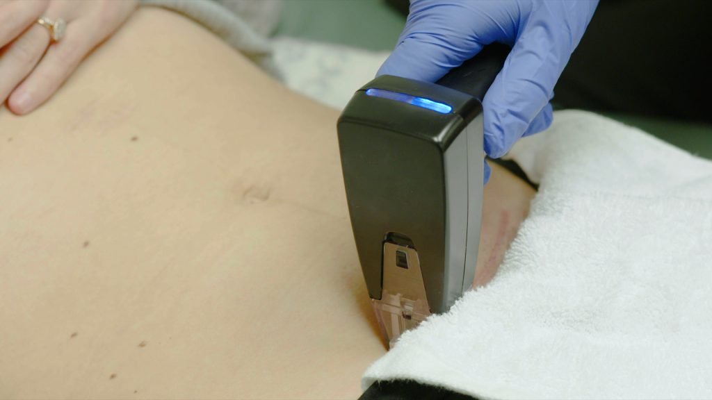 Cellulite Reduction Tampa image 1